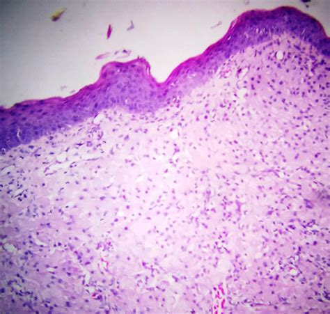 Pathology Outlines Congenital Granular Cell Epulis