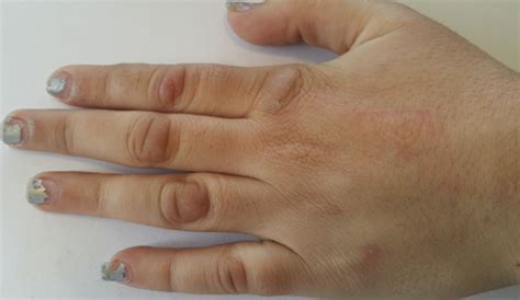 Pseudo Knuckle Pads A Bridge To Psychodermatology Auctores