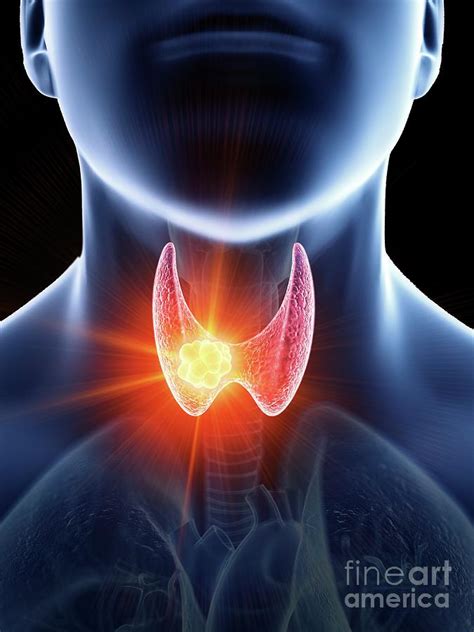 Illustration Of A Mans Thyroid Gland Cancer Photograph By Sebastian