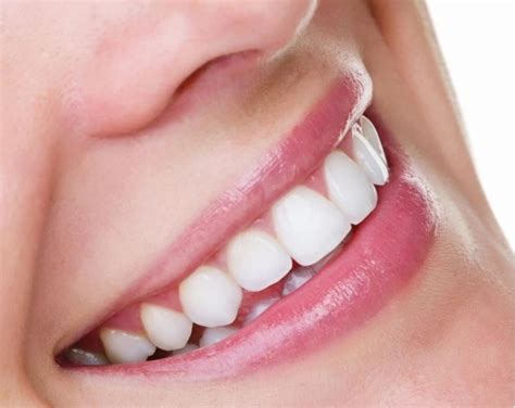 Best Teeth Whitening Sydney North Ryde Dentistry