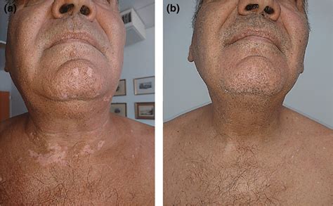 A Patient With Plaque Psoriasis And Vitiligo Before Treatment With