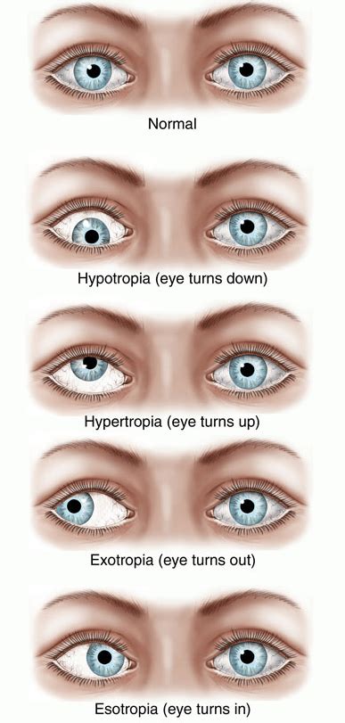 Causes Symptoms And Lazy Eye Natural Treatment Options Makari Wellness