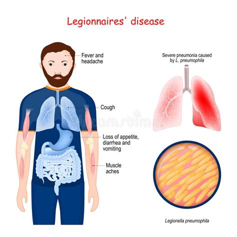 Choroba Legionistów Atypowe Zapalenie Płuc Wywołane Przez Bakterie Legionella Ilustracja Wektor
