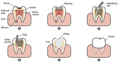 Check spelling or type a new query. Root Canal Treatment at Rock House Dental Practice ...