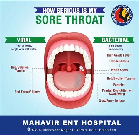 Sore Throat Throat Irritation Throat Ulcers Viral Sore Throat