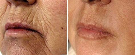 Smokers Lines Perioral Line Filler Derma Models Botox Face How