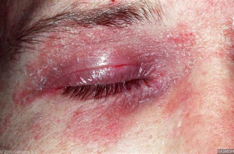Seborrheic Dermatitis Eyelids