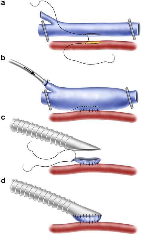 A Novel Method Of Vein Cuff Creation For Below Knee Femoropopliteal