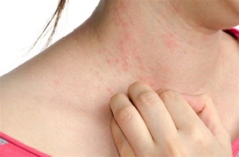 8 Causes Of Allergic Itching Skin Rashes That Itch Itching Skin Dry