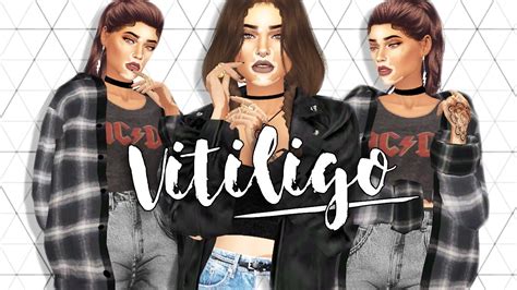 The Sims 4 Vitiligo Create A Sim Youtube