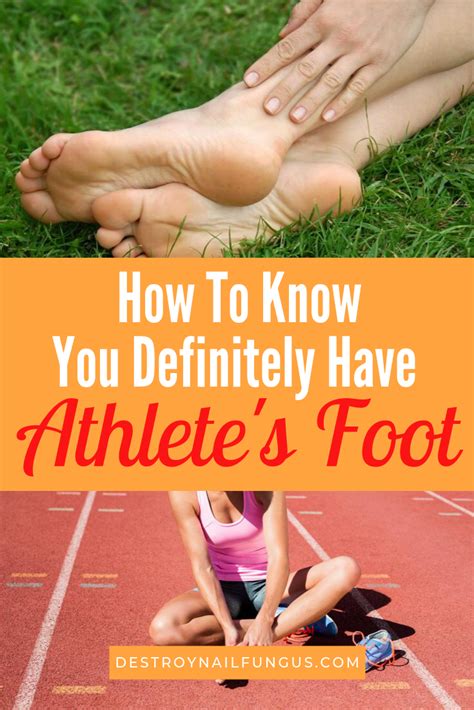 Signs That You Have Athletes Foot The 3 Crucial Signs
