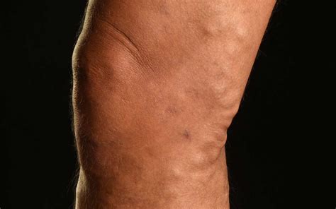 Varicose Veins What Is The Cause And What Treatment