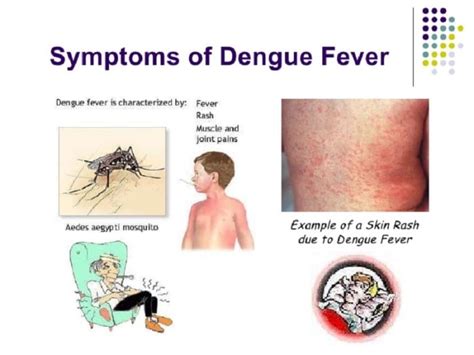 Dengue Fever Symptoms Treatments Prevention Human N Health