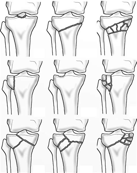 Aoota Classi Fi Cation Of Proximal Tibial Fractures A1 A3 Contains
