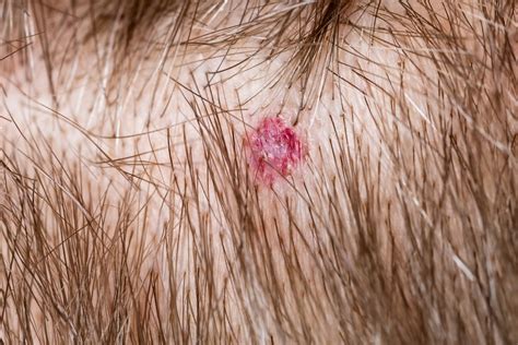 Treating Bacterial Scalp Infections To Prevent Hair Loss