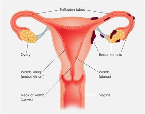 Endometriosis What Is It And How Does It Affect Fertility Virginia Center For Reproductive