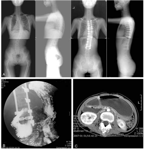A 14 Year Old Girl With Adolescent Idiopathic Scoliosis A Whole