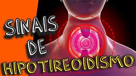 Hipotiroidismo Sintomas Causas E Tratamento Do Hipotiroeidismo Youtube