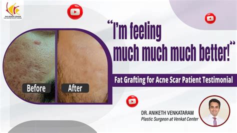 Acne Scars Treatment Patient Review Fat Grafting For Deep Acne Scars