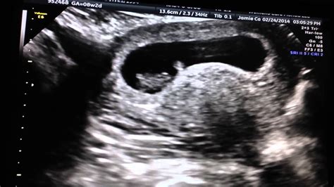 Baby Williams 8 Weeks 2 Days Ultrasound Youtube