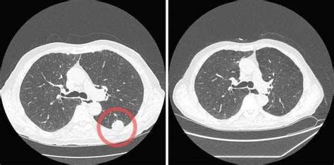 Medicare To Cover Low Dose Ct Screening For Lung Cancer
