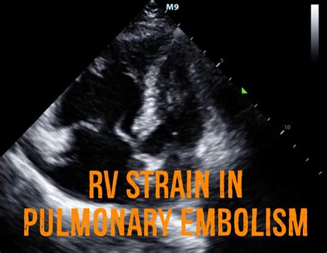 Hennepin Ultrasound Right Ventricular Strain In Pulmonary Embolism