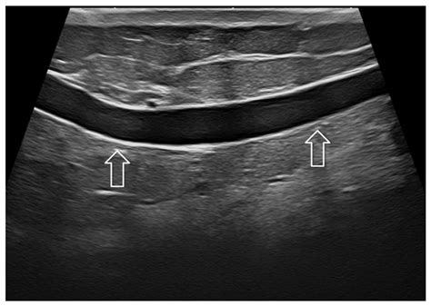 Jpm Free Full Text Use Of High Frequency Transducers In Breast