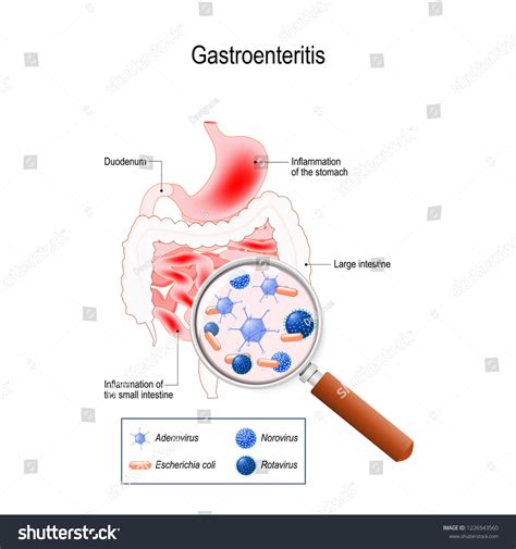 Gastroenteritis Infectious Diarrhea Inflammation Gastrointestinal Tract