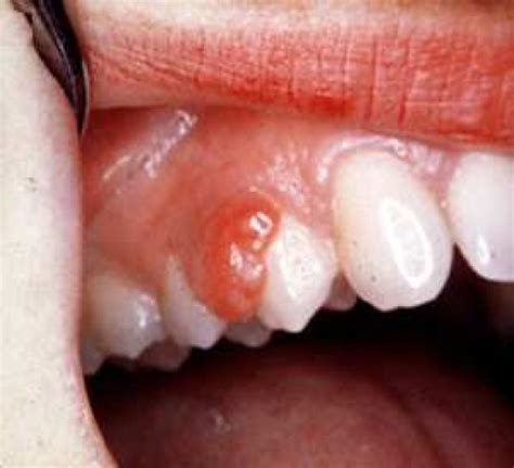 Pyogenic Granuloma Teeth Patient