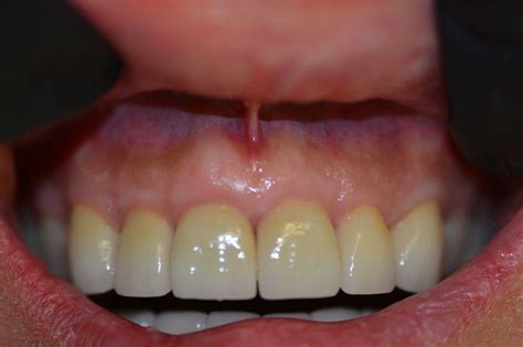 Laser Gum And Bone Grafts Kamloops Periodontist