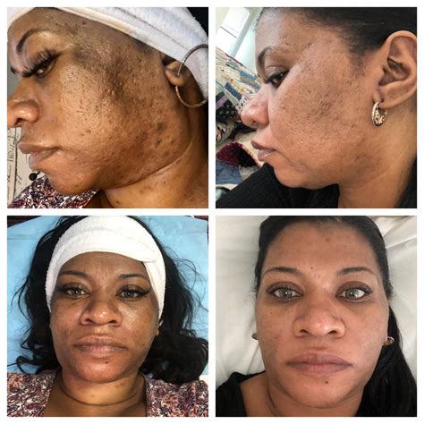 Banda 6 Months And 4 Treatments With Microneedling Skinpen 2 Weeks