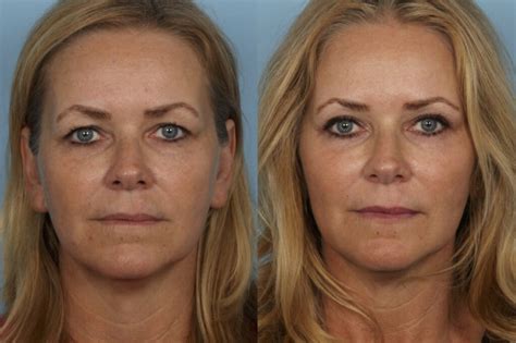 Blepharoplasty Chicago Eyelid Surgery Dr Sidle