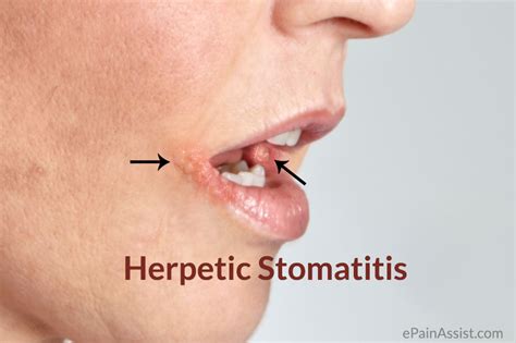Herpetic Stomatitis Causes Signs Symptoms Diagnosis Treatment