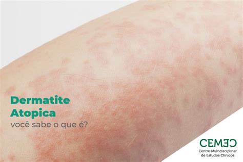 Dermatite Atópica CEMEC