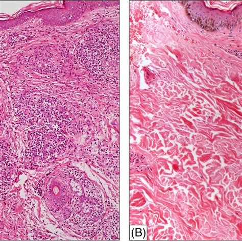 A Clinical Images Showing Well Defined Erythematous Indurated Plaque