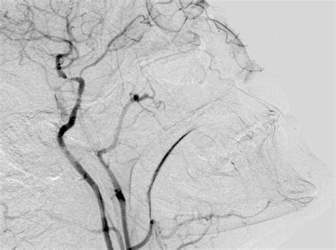 Left Internal Carotid Artery Stenosis Cavernous Part Download