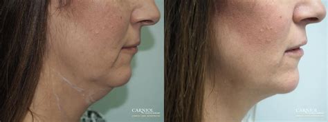 Non Surgical Neck Lift Before And After Gallery