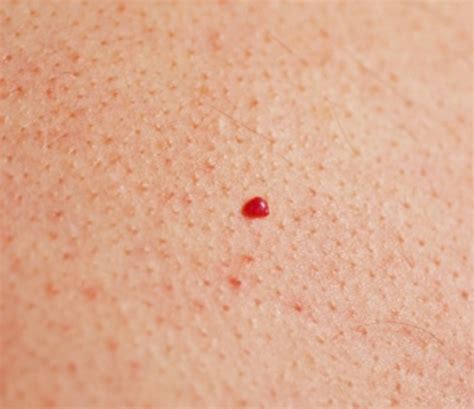 Cherry Angiomas Pictures Symptoms Causes Treatment Removal Healdove