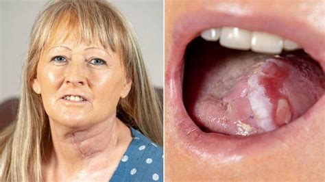 report 58 year old joanna smith gets a new tongue made from a vein and pieces of her arm