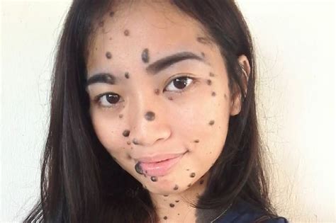 Woman Relentlessly Bullied For Mole Covered Face And Cruelly Branded A