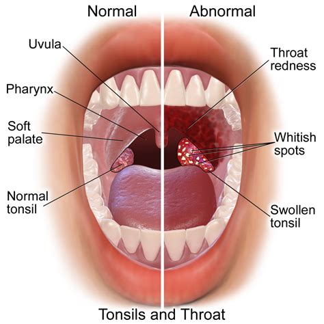 strep throat vs sore throat causes treatments preventions