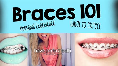 Braces My Experience And Things To Expect 1 Youtube