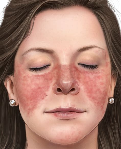 Autoimmune Disease Skin Rash On Face Printable Templates Protal