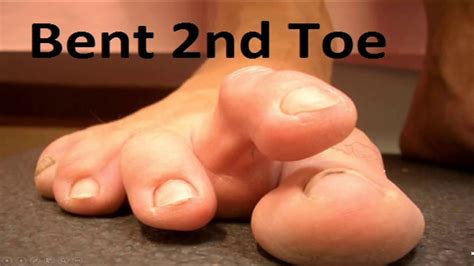 Simple Tricks For Claw And Hammer Toes Home Treatment Guide Youtube