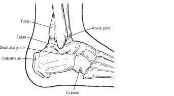 Fractures Of The Calcaneus Heel Bone Fractures Podiatrist In Laguna