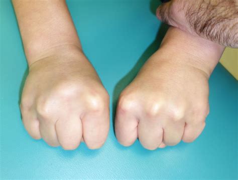 Short Fingers Brachydactyly Congenital Hand And Arm Differences
