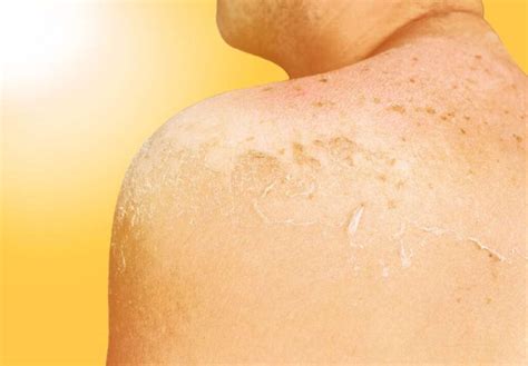 5 Ways To Soothe The Sting Of Sunburn We Golden Age