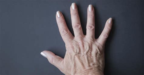 Can Low Salt Intake Improve Bulging Veins On Your Hands Livestrongcom