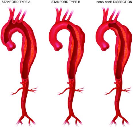 Aortic Dissection