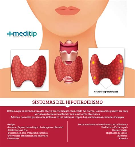 El Tratamiento Del Hipotiroidismo Y Sus Deficiencias Meditip